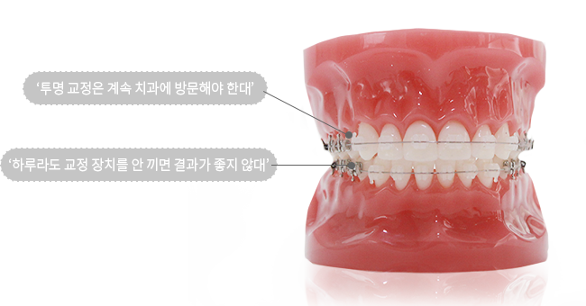 투명 교정은 계속 치과에 방문해야 한대/하루라도 교정 장치를 안 끼면 결과가 좋지 않대